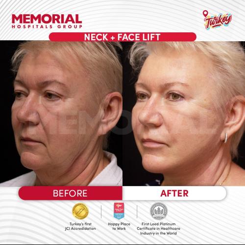 Thread lift Before / After photo