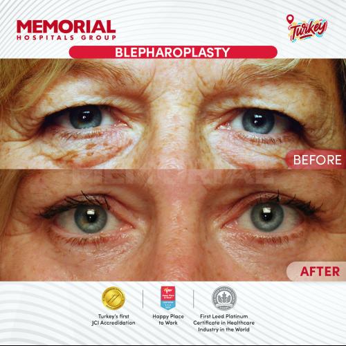 Dark circles treatment Before / After photo