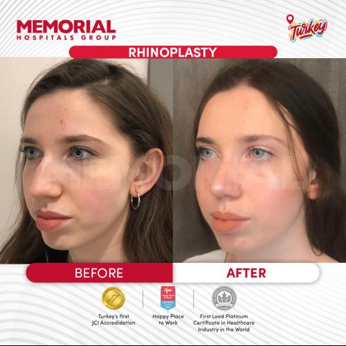 Rhinoplastie Photo avant/après