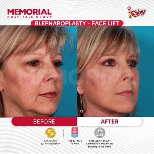 Dark circles treatment Before / After photo