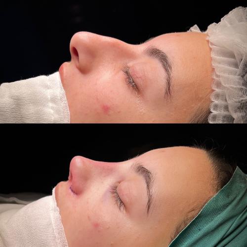 Ultrasound Rhinoplasty Before / After photo