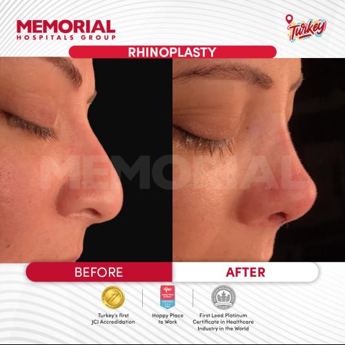 عملية تجميل الأنف صور قبل وبعد