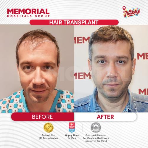 Trasplante de barba Foto antes/después