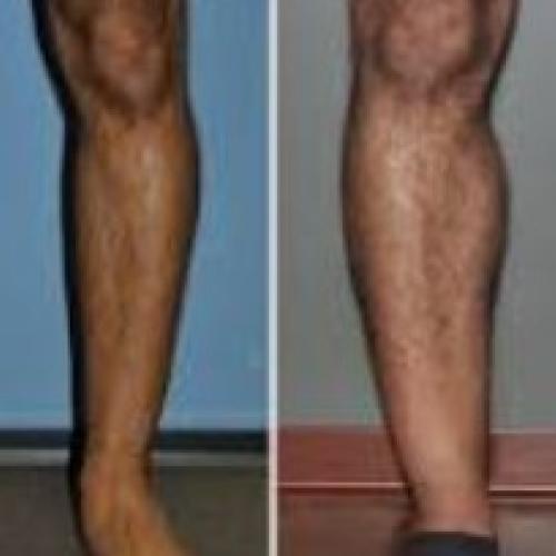 Calf implants Before / After photo