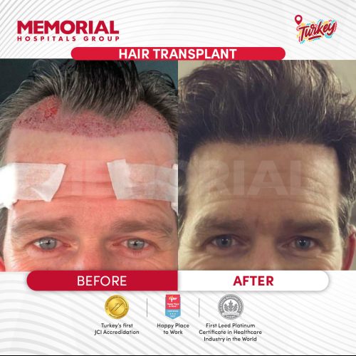 Photos Avant / Après - Chirurgie du front - Prof. Dr. Mustafa Tonguç İşken