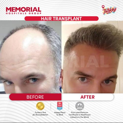 Photos Avant / Après - Chirurgie du front - Prof. Dr. Mustafa Tonguç İşken