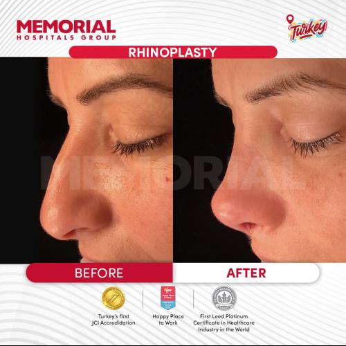 Rhinoplastie Photo avant/après