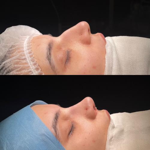 Ultrasound Rhinoplasty Before / After photo