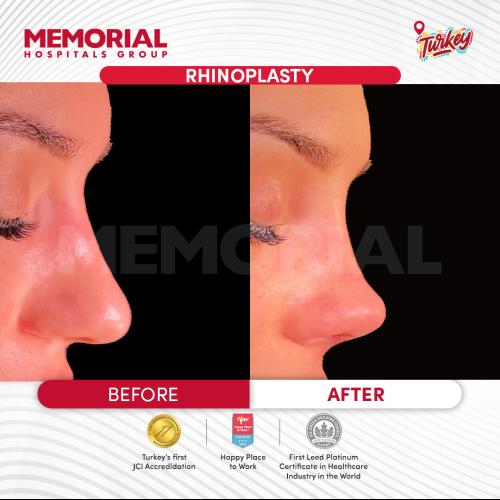 Rhinoplastie Photo avant/après
