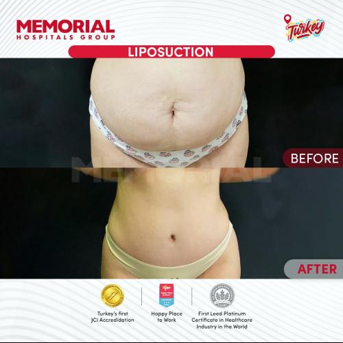 Before after photos of our patients 1