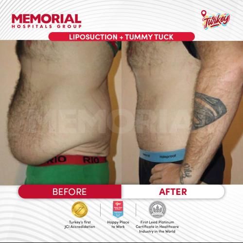 Liposucción Foto antes/después