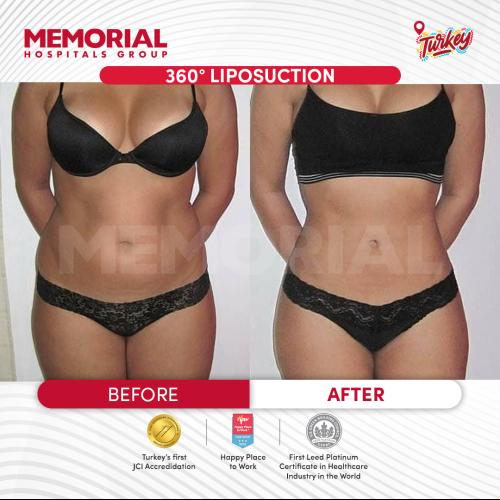 Liposucción Foto antes/después