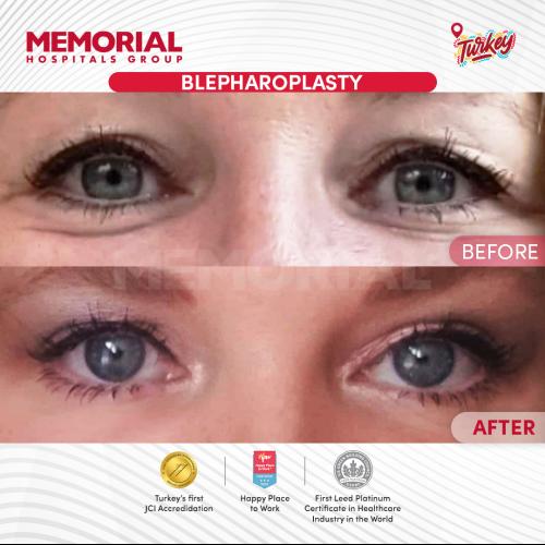 Dark circles treatment Before / After photo