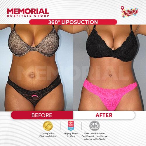 Liposucción Foto antes/después