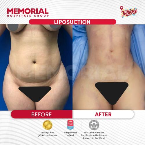 Cirugía del lipoedema Foto antes/después