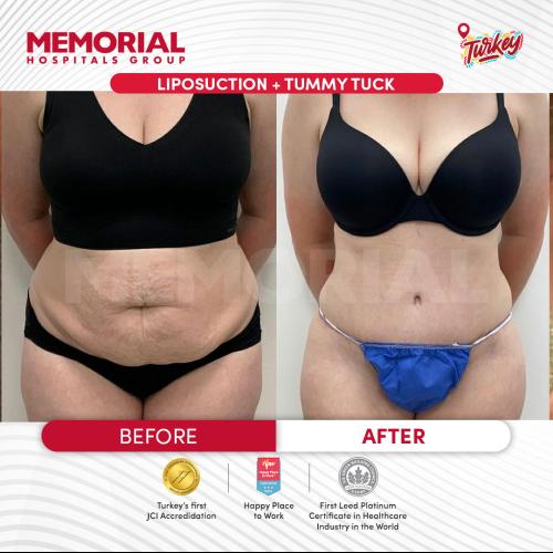 Abdominoplastie Photos avant & après
