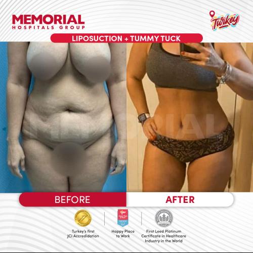 Abdominoplastie Photos avant & après