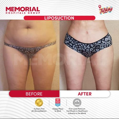Cirugía del lipoedema Foto antes/después