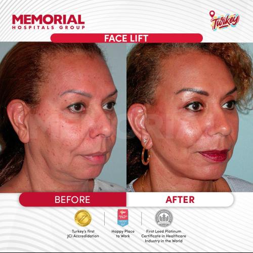 Thread lift Before / After photo