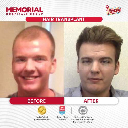 Photos Avant / Après - Chirurgie du front - Prof. Dr. Mustafa Tonguç İşken