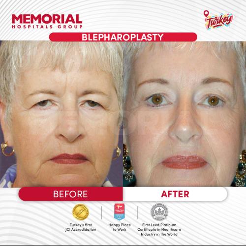 Dark circles treatment Before / After photo