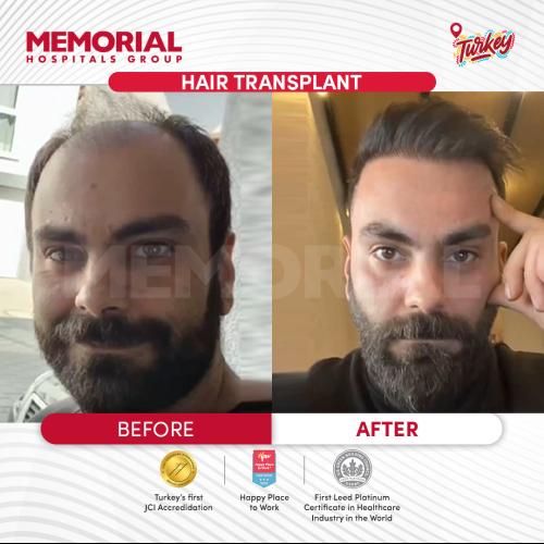 Trasplante de barba Foto antes/después