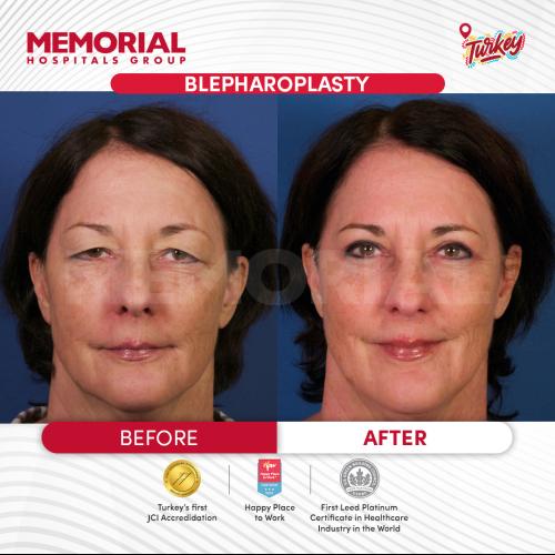 Photos Avant / Après 6