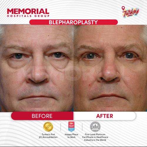 Photos Avant / Après 3