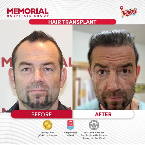 Trasplante de barba Foto antes/después