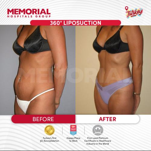 Liposucción Foto antes/después
