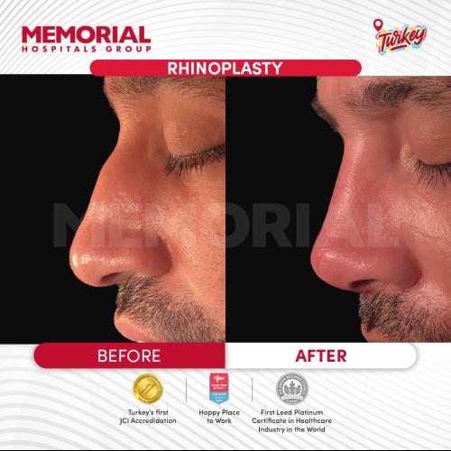 fotos antes y después de nuestros pacientes 4