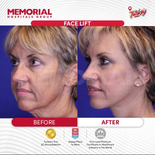 Thread lift Before / After photo