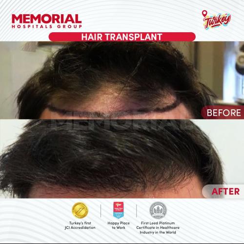 زراعة الشعر صور قبل وبعد