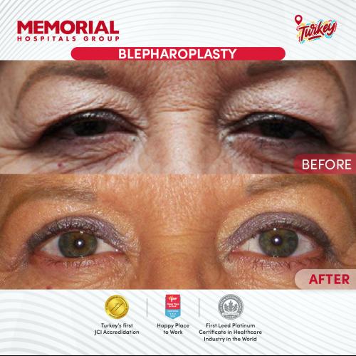 Dark circles treatment Before / After photo