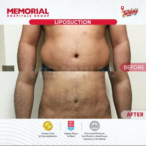 Cirugía del lipoedema Foto antes/después