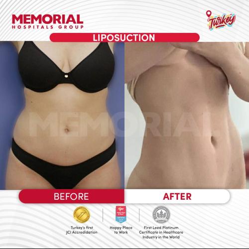 Cirugía del lipoedema Foto antes/después