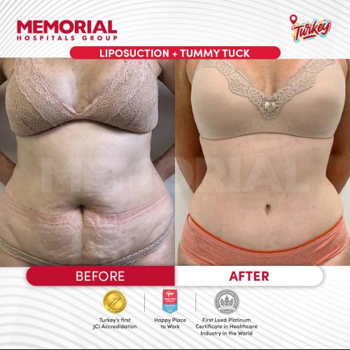 Abdominoplastie Photos avant & après