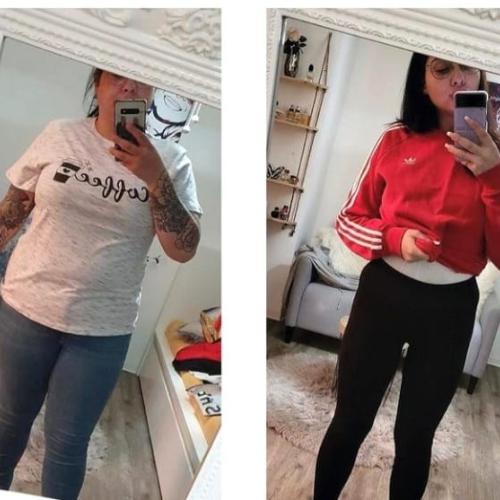 Consultation for bariatric surgery Before / After photo
