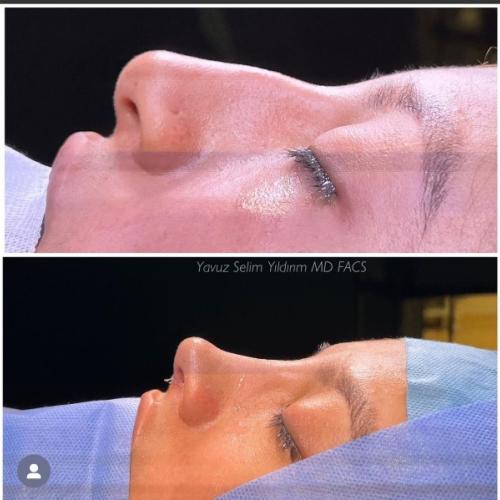 Septorrinoplastia Foto antes/después