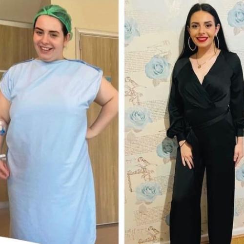 Consultation for bariatric surgery Before / After photo