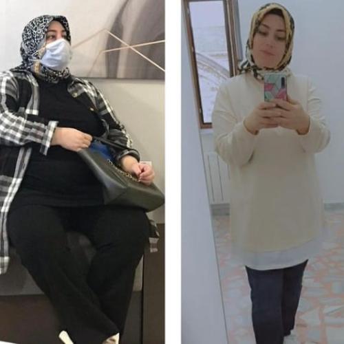 Consultation for bariatric surgery Before / After photo