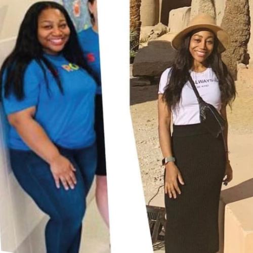 Consultation for bariatric surgery Before / After photo