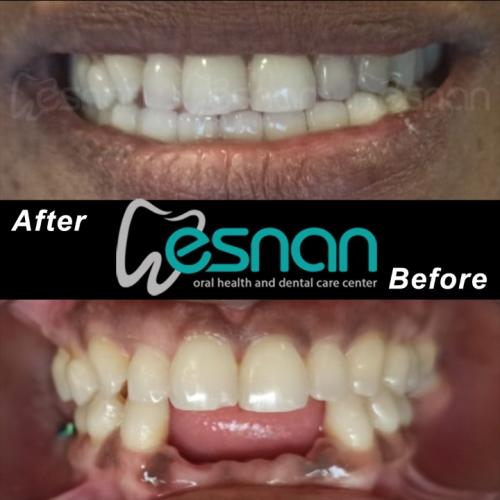 Denture Before / After photo