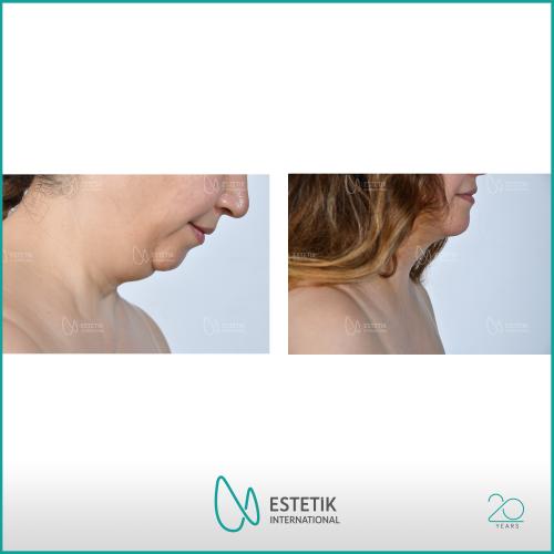 Chin augmentation Before / After photo