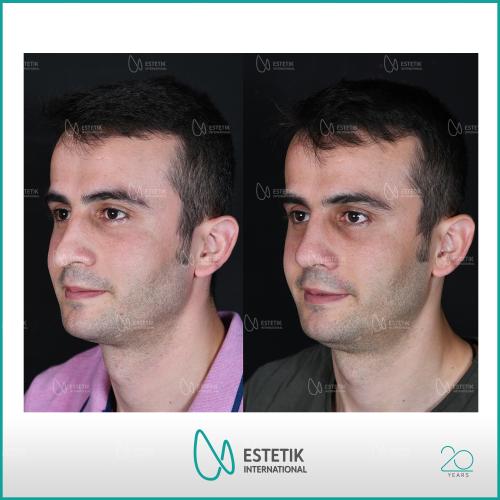 Before after photos of our patients 2