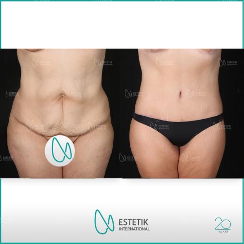Before after photos of our patients 11