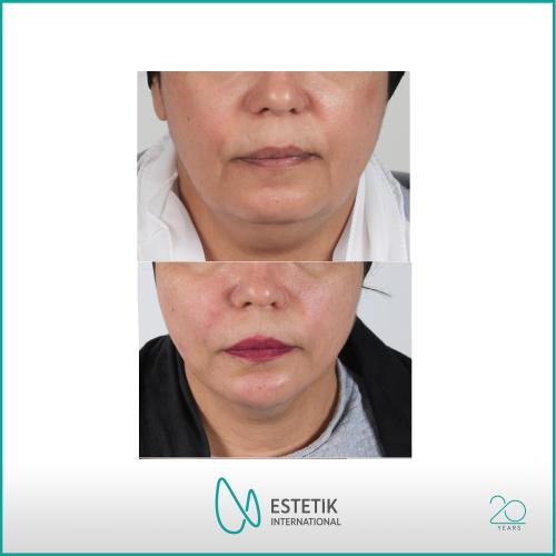 Before after photos of our patients 3