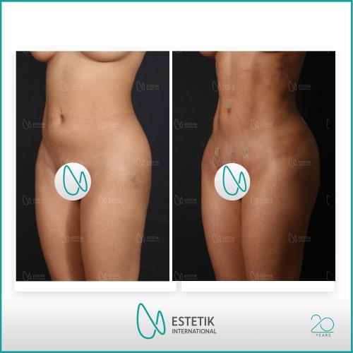 Pubic liposuction Before / After photo