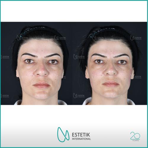 صور قبل وبعد لمرضانا - البوتوكس - د. مرفة أوفلاز
