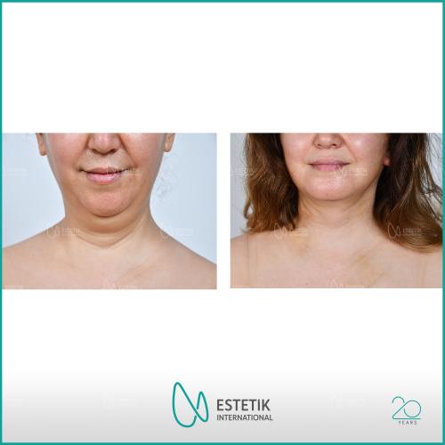 Chin augmentation Before / After photo